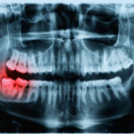 Does amerigroup cover wisdom teeth removal carefirst comp state md